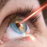 انواع روش های جراحی لیزر