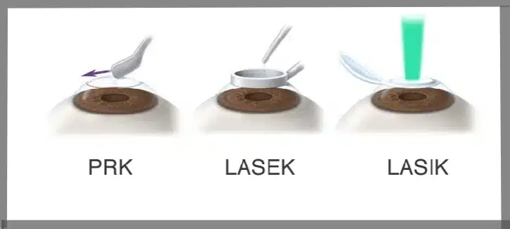 مقایسه 3 عمل لیزیک، لازک و PRK