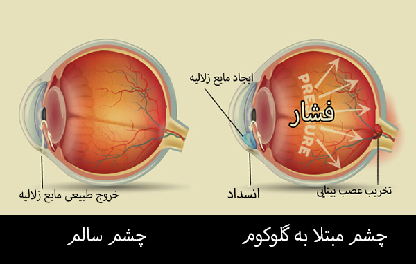 تفاوت چشم سالم با چشم بیمار مبتلا به آب سیاه (گلوکوم)