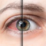 خشکی چشم؛ علت، علائم و درمان خانگی این مشکل چشمی